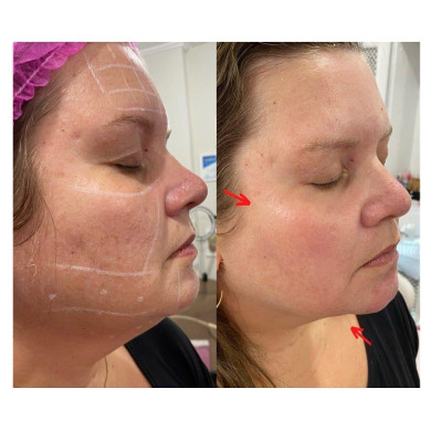 antes e depois botox 5