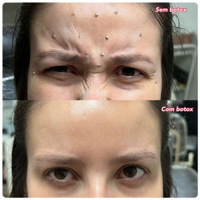 antes e depois botox 1