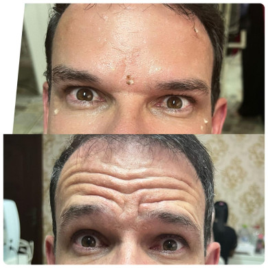 antes e depois botox 3