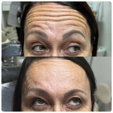 antes e depois botox 2
