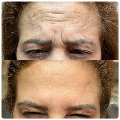 antes e depois botox
